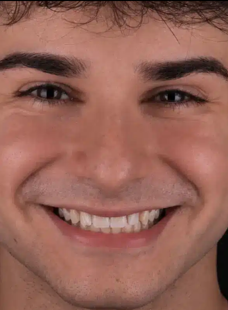 Lentes de Contato — antes